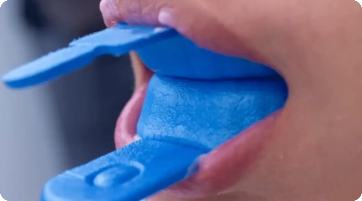 Fluoride Gel Application